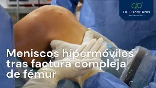 Meniscos hipermóviles tras factura compleja de fémur - Dr. Oscar Ares