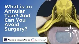 What is an Annular Tear? And How Do You Treat It Without Surgery?