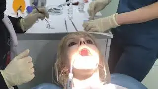 Woman at the dentist watches as her tooth is filled with amalgam