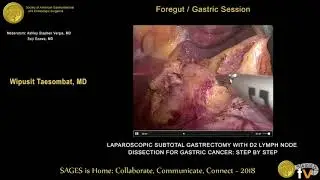 Laparoscopic subtotal gastrectomy with D2 lymph node dissection for gastric cancer - Step by step