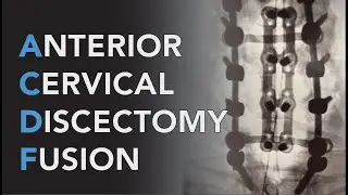 Fused Episode 5: Anterior Cervical Discectomy and Fusion Surgery (ACDF)