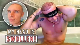 Swollen head after hair transplant