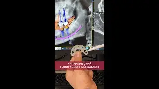 Хирургический навигационный шаблон