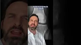 💡Lesão do LCA e a fratura de Segond - Parte 1 de 2