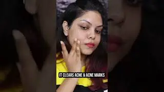 Getting Rid Of Acne Has Become Easier Than Ever Before