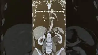 На снимках КТ уретеропиелокаликоэктазия слева