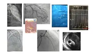 Interesting coronary angiograms and decision-making -3