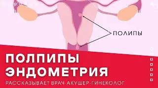 Полипы эндометрия: симптомы и лечение