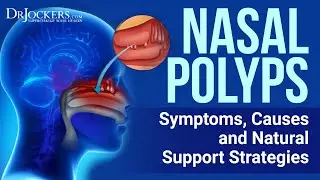 Top 12 Natural Remedies for Nasal Polyps