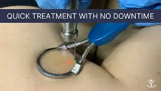 Laser Treatment for Spider Veins on Legs
