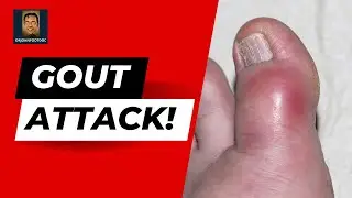 Gout Tophi Squeeze