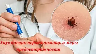 Укус клеща: первая помощь и меры предосторожности.