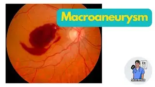 Retinal Macroaneurysm I Eye Dr Explains 2023