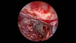 Endoscopic view of CP angle post tumour resection