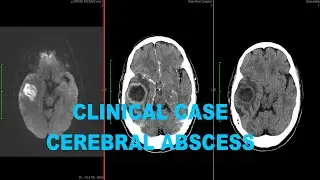 Clinical Case: Cerebral abscess on CT and MRI