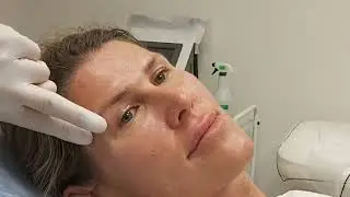 Меди-Лайт. Коррекция морщин на лбу.