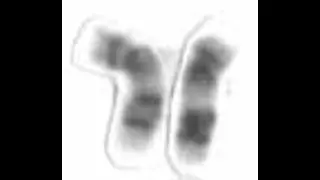 Charcot–Marie–Tooth disease