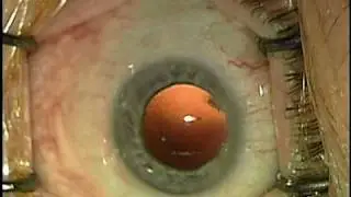 High Efficiency Cataract Surgery by Dr. Shawn Cohen, McGill University, Montreal