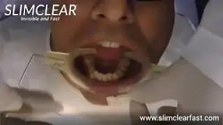 Indirect bonding - SlimClear