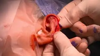 Dr. John E. Sherman - Correction of Macrotia Surgery