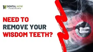 Stop! Watch This Before Removing Your Wisdom Teeth | Dentist Explained 2025