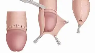 Обрезание члена у мужчин, видео, фото, обрезание крайней плоти, плюсы, минусы