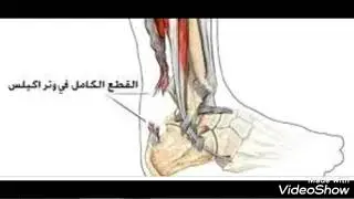 عرض إصابات وتر إكيليس