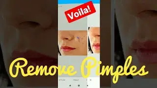Watch How to REMOVE PIMPLES in less than 1Second