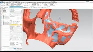 Как создать лицевой имплантат инструментами реинжиниринга в NX. Ver. 1.0  | Medical engineering NX