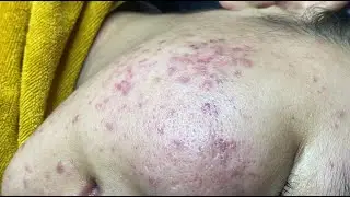 Inflamatory acne causes painful ( V.A P2) #HoangMySpa102
