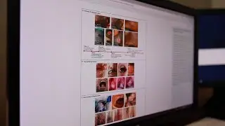 Monkeypox Treatment in the Valley