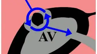 4.7 Nhịp nhanh vào lại nút nhĩ thất (AVNRT)