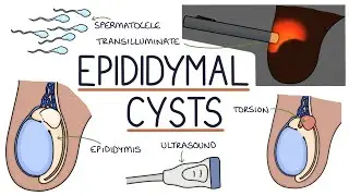 Understanding Epididymal Cysts