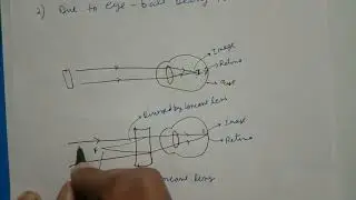 Myopia and Hypermetropia Class 10