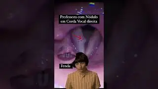 Calo em corda vocal de professora, retorno da voz em 7 dias, microcirurgia da laringe
