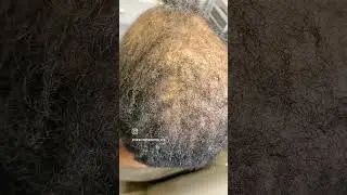 Results in 4 Weeks on My Hair Loss Customer. The Alopecia Doctor Hair and Scalp Spa. Houston, TX
