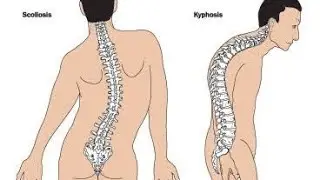 Lumbar Surgery / Spinal Cord Surgery