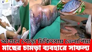 পুড়ে যাওয়া ক্ষতস্থানের চিকিৎসায় তেলাপিয়া মাছের চামড়া ব্যবহারে সাফল্য পেল বিজ্ঞানীরা!