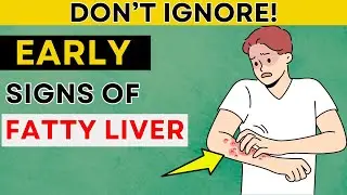 DON'T IGNORE! These 8 Early Signs of Fatty Liver | Daily Joy