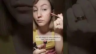 Перекосило губы после стоматолога 😬 