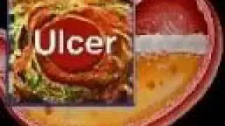 Ulcers