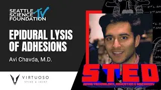 Epidural Lysis of Adhesions - Avi Chavda, M.D.