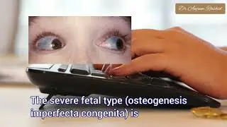 Osteogenesis Imperfecta Symptoms, Cause, Genetics, Radiology & Treatment | Brittle Bone Disease