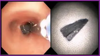 Pediatric Lung Foreign Body Removal Of Iron Piece শিশুর ফুসফুস থেকে লোহার টুকরো বের হল #BD_ENDOSCOPY
