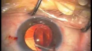 E3 PV en aspiracion vit SIS23 LIO en restos_.wmv