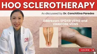 VARICOSE AND SPIDER VEINS TREATMENT