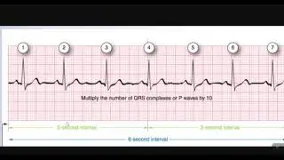 Heart Rate Calculation (6 seconds mothod)