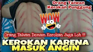 Vlog TKW Taiwan ●Kerokan Karena  Masuk Angin | Bantuin Tetangga Kerokan Punggung Karena Masuk Angin