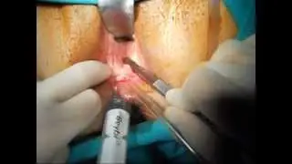 Rektosel (barsak fıtığı) onarımı-Dr.Menteş, Dr.Leventoğlu, Dr.Ege