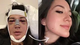 I Got More Plastic Surgery... and Got Botched | VLOG